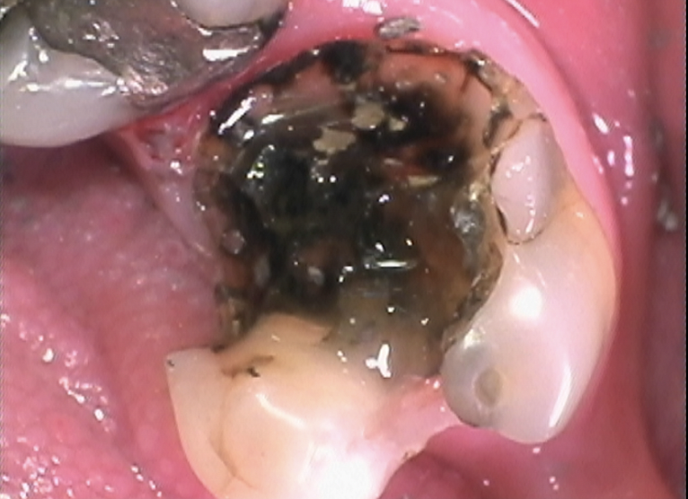 Before treatment: a tooth with extensive decay and a failing old restoration